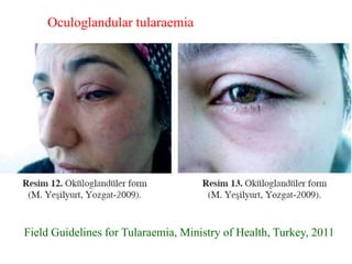 Field Guidelines for Tularaemia, Ministry of Health, Turkey, 2011
Oculoglandular tularaemia
 