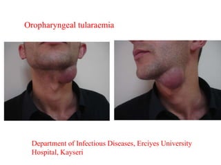 Department of Infectious Diseases, Erciyes University
Hospital, Kayseri
Oropharyngeal tularaemia
 
