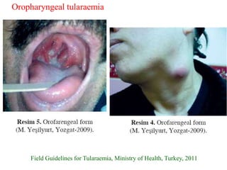 Field Guidelines for Tularaemia, Ministry of Health, Turkey, 2011
Oropharyngeal tularaemia
 
