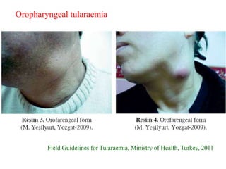 Field Guidelines for Tularaemia, Ministry of Health, Turkey, 2011
Oropharyngeal tularaemia
 
