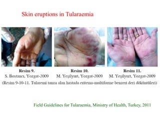Field Guidelines for Tularaemia, Ministry of Health, Turkey, 2011
Skin eruptions in Tularaemia
 