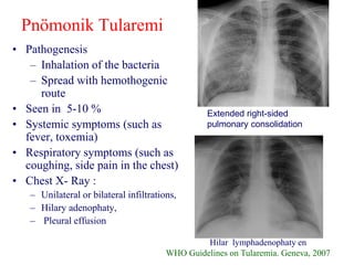 Pnömonik Tularemi
• Pathogenesis
– Inhalation of the bacteria
– Spread with hemothogenic
route
• Seen in 5-10 %
• Systemic symptoms (such as
fever, toxemia)
• Respiratory symptoms (such as
coughing, side pain in the chest)
• Chest X- Ray :
– Unilateral or bilateral infiltrations,
– Hilary adenophaty,
– Pleural effusion
Extended right-sided
pulmonary consolidation
Hilar lymphadenophaty en
WHO Guidelines on Tularemia. Geneva, 2007
 