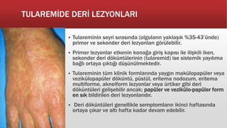 TULAREMİDE DERİ LEZYONLARI
 Tulareminin seyri sırasında (olguların yaklaşık %35-43’ünde)
primer ve sekonder deri lezyonları görülebilir.
 Primer lezyonlar etkenin konağa giriş kapısı ile ilişkili iken,
sekonder deri döküntülerinin (tularemid) ise sistemik yayılıma
bağlı ortaya çıktığı düşünülmektedir.
 Tulareminin tüm klinik formlarında yaygın makülopapüler veya
vezikülopapüler döküntü, püstül, eritema nodozum, eritema
multiforme, akneiform lezyonlar veya ürtiker gibi deri
döküntüleri gelişebilir ancak; papüler ve vezikülo-papüler form
en sık bildirilen deri lezyonlarıdır.
 Deri döküntüleri genellikle semptomların ikinci haftasında
ortaya çıkar ve altı hafta kadar devam edebilir.
 