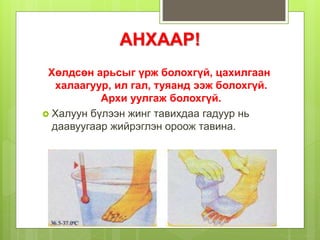АНХААР!
Хөлдсөн арьсыг үрж болохгүй, цахилгаан
халаагуур, ил гал, туяанд ээж болохгүй.
Архи уулгаж болохгүй.
 Халуун бүлээн жинг тавихдаа гадуур нь
даавуугаар жийрэглэн ороож тавина.
 