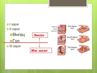  I зэрэг
 II зэрэг
Өнгөц
Гүн
 III зэрэг
Мэс засал
Эмийн
 