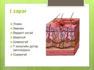 I зэрэг
 Улаан
 Зөөлөн
 Өвдөлт ихтэй
 Шархгүй
 Цэврүүгүй
 7 хоногийн дотор
эмчлэгдэнэ
 Сорвигүй
 