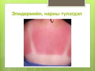 Эпидермийн, нарны түлэгдэл
 