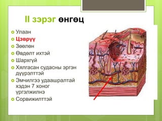 II зэрэг өнгөц
 Улаан
 Цэврүү
 Зөөлөн
 Өвдөлт ихтэй
 Шархгүй
 Хялгасан судасны эргэн
дүүрэлттэй
 Эмчилгээ удаашралтай
хэдэн 7 хоног
үргэлжилнэ
 Сорвижилттэй
 