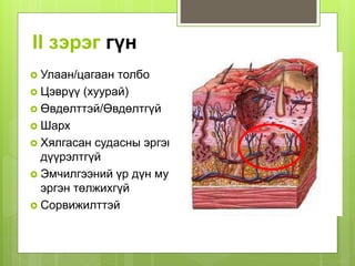 II зэрэг гүн
 Улаан/цагаан толбо
 Цэврүү (хуурай)
 Өвдөлттэй/Өвдөлтгүй
 Шарх
 Хялгасан судасны эргэн
дүүрэлтгүй
 Эмчилгээний үр дүн муу
эргэн төлжихгүй
 Сорвижилттэй
 