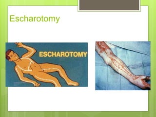Escharotomy
 