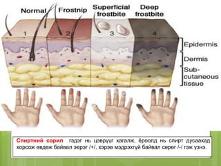 Спиртний сорил гэдэг нь цэврүүг хагалж, ёроолд нь спирт дусаахад
хорсож өвдөж байвал эерэг /+/, хэрэв мэдрэхгүй байвал сөрөг /-/ гэж үзнэ.
 