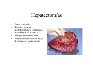 Hepatectomías
• Casos resecables
• Requiere manejo
  multidisciplinario (oncólogos,
  hepatólogos, cirujanos, etc)
• Márge...