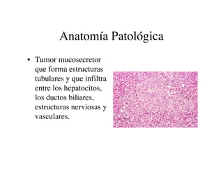 Anatomía Patológica
• Tumor mucosecretor
  que forma estructuras
  tubulares y que infiltra
  entre los hepatocitos,
  los...