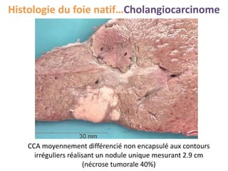 Histologie du foie natif…Cholangiocarcinome
CCA moyennement différencié non encapsulé aux contours
irréguliers réalisant un nodule unique mesurant 2.9 cm
(nécrose tumorale 40%)
 