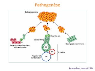Pathogenèse
Cytoto
A prag
ABC-2
biliary
either
gemcit
therap
11·7 m
gemcit
95% C
and in
to this
The be
small
other o
not pr
gemcit
therap
improv
signall
biology
The
Figure2:Potentialcellsof origininintrahepaticcholangiocarcinoma
PV=portal vein.HA=hepaticartery.BD=bileduct.HC=hepaticcell.
Cholangiocarcinoma
Hepatocytetransdifferentiation
andtransformation
Progenitor cell
transformation
Progenitor cells
Canal of Hering
BD
HC
Portal triad
Cholangiocytetransformation
HA
PV
Razumilava, Lancet 2014
 