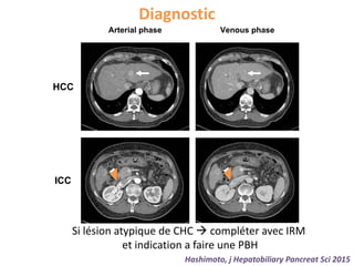 Diagnostic
Hashimoto, j Hepatobiliary Pancreat Sci 2015
ever, the use of liver transplantation
a is controversial due to a low sur-
h recurrence rate and is currently
and potential practices that could help expand access to
transplantation for patients with ICC.
Arterial phase Venous phase
HCC
ICC
phy
ld
ased
assi-
nd
cir-
e a
ci-
ment
s
a
ma
al
t
con-
ous
139ci (2015) 22:138–143
Si lésion atypique de CHC  compléter avec IRM
et indication a faire une PBH
 