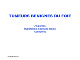 TUMEURS BENIGNES DU FOIE
Angiomes
Hyperplasie nodulaire focale
Adénomes
Claude EUGENE 1
 