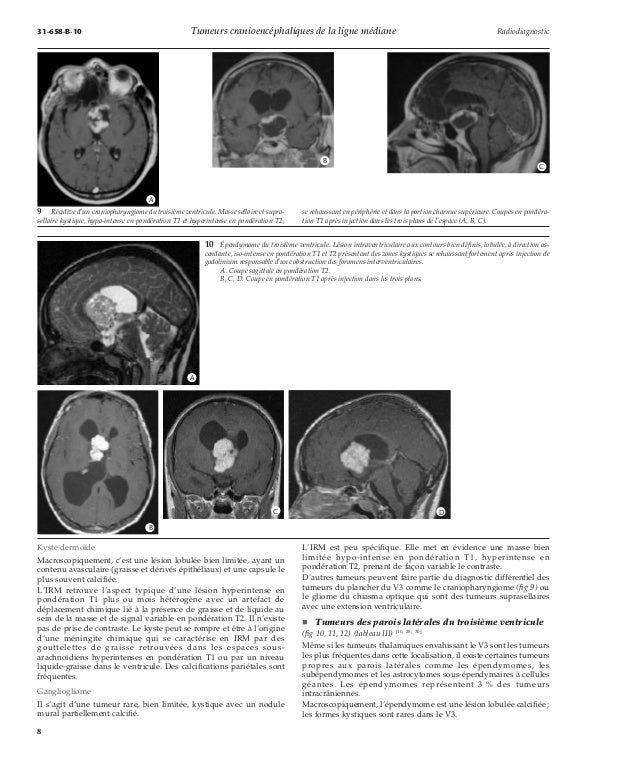 Tumeurs cranioencéphaliques de la ligne médiane