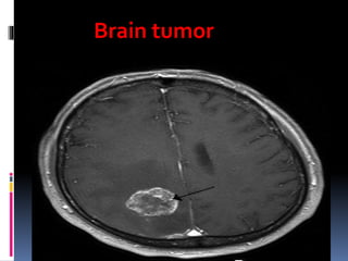 Brain tumor
 