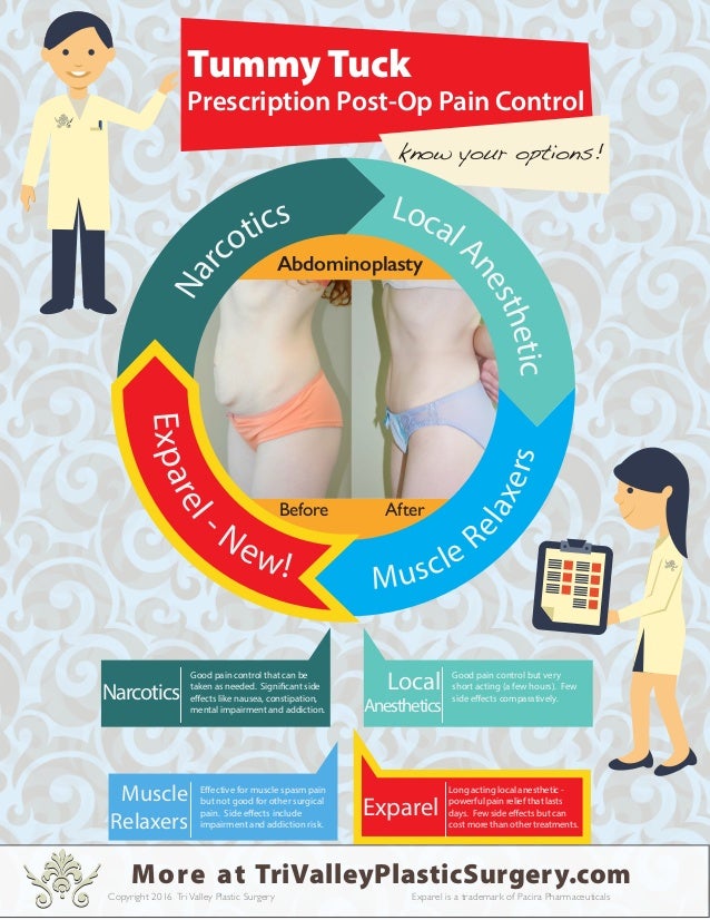 Tummy Tuck Exparel Infographic - 638x826 - jpeg Abdominoplasty Side Effects