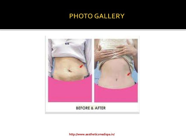 Tummy Tuck Surgery in Pune in affordable prices at Aesthetics Medispa