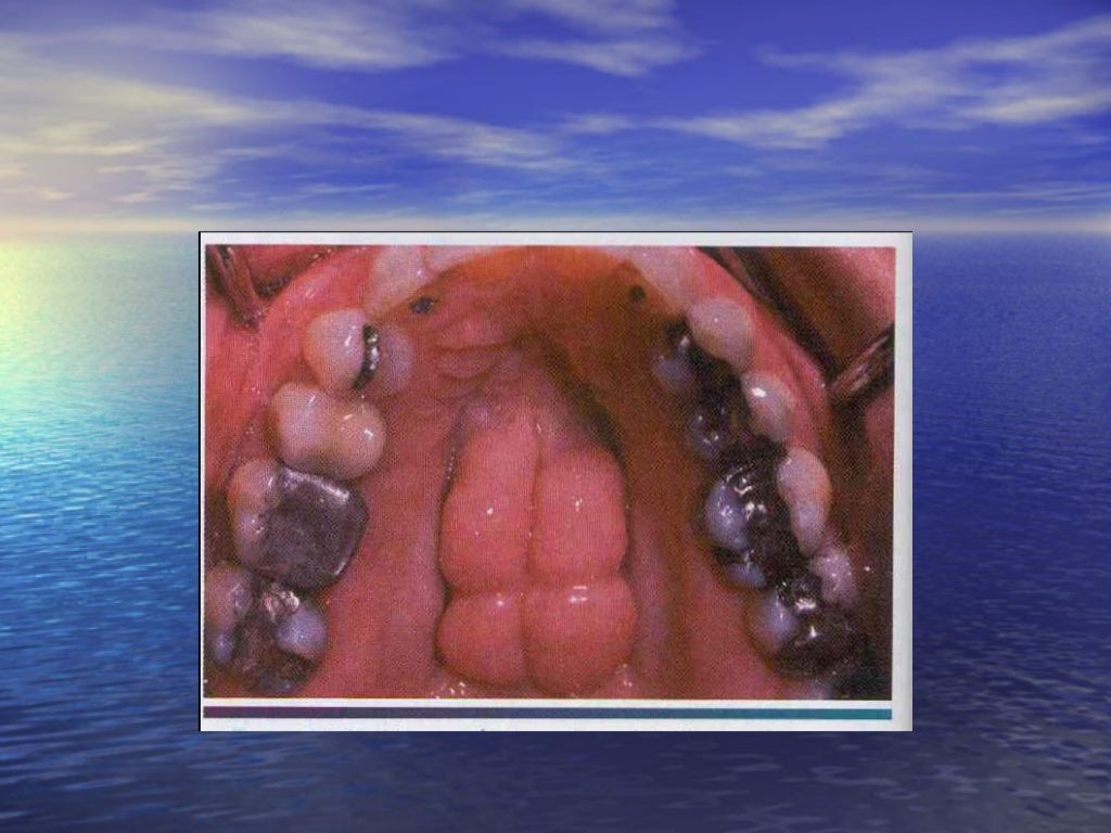 Tumor of oral cavity