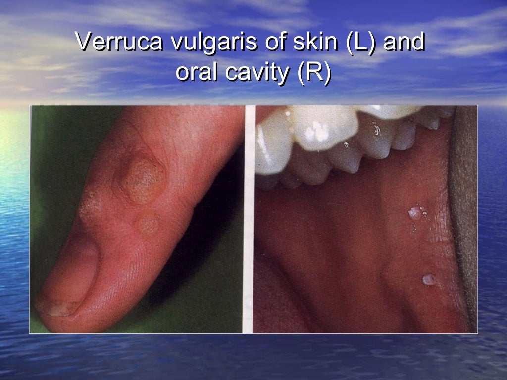 Tumor of oral cavity