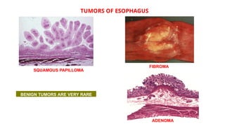 esophageal Tumor and ethiology and treatment.ppt