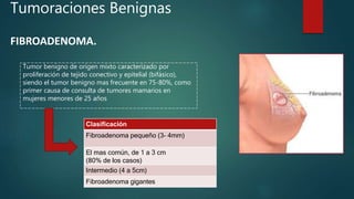 Tumoraciones Benignas
Tumor benigno de origen mixto caracterizado por
proliferación de tejido conectivo y epitelial (bifásico),
siendo el tumor benigno mas frecuente en 75-80%, como
primer causa de consulta de tumores mamarios en
mujeres menores de 25 años
Clasificación
Fibroadenoma pequeño (3- 4mm)
El mas común, de 1 a 3 cm
(80% de los casos)
Intermedio (4 a 5cm)
Fibroadenoma gigantes
FIBROADENOMA.
 