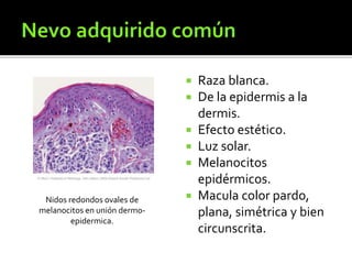  Raza blanca.
 De la epidermis a la
dermis.
 Efecto estético.
 Luz solar.
 Melanocitos
epidérmicos.
 Macula color pardo,
plana, simétrica y bien
circunscrita.
Nidos redondos ovales de
melanocitos en unión dermo-
epidermica.
 