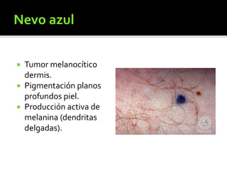  Tumor melanocítico
dermis.
 Pigmentación planos
profundos piel.
 Producción activa de
melanina (dendritas
delgadas).
 