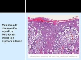 Melanoma de
diseminación
superficial.
Melanocitos
atípicos en
espesor epidermis
 