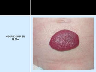 HEMANGIOMA EN
FRESA
 