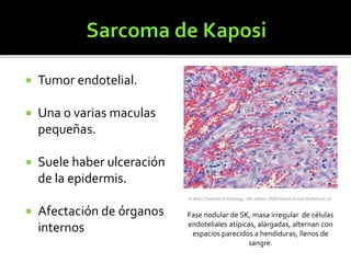  Tumor endotelial.
 Una o varias maculas
pequeñas.
 Suele haber ulceración
de la epidermis.
 Afectación de órganos
internos
Fase nodular de SK, masa irregular de células
endoteliales atípicas, alargadas, alternan con
espacios parecidos a hendiduras, llenos de
sangre.
 