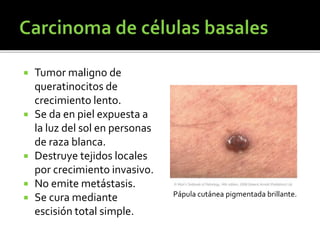  Tumor maligno de
queratinocitos de
crecimiento lento.
 Se da en piel expuesta a
la luz del sol en personas
de raza blanca.
 Destruye tejidos locales
por crecimiento invasivo.
 No emite metástasis.
 Se cura mediante
escisión total simple.
Pápula cutánea pigmentada brillante.
 