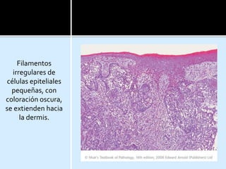 Filamentos
irregulares de
células epiteliales
pequeñas, con
coloración oscura,
se extienden hacia
la dermis.
 