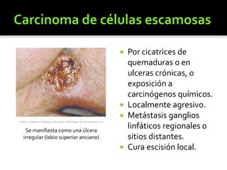  Por cicatrices de
quemaduras o en
ulceras crónicas, o
exposición a
carcinógenos químicos.
 Localmente agresivo.
 Metástasis ganglios
linfáticos regionales o
sitios distantes.
 Cura escisión local.
Se manifiesta como una úlcera
irregular (labio superior anciano)
 