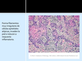 Forma filamentos
muy irregulares de
células epiteliales
atípicas, invaden la
piel e inducen a
respuesta
inflamatoria.
 