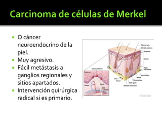  O cáncer
neuroendocrino de la
piel.
 Muy agresivo.
 Fácil metástasis a
ganglios regionales y
sitios apartados.
 Intervención quirúrgica
radical si es primario.
 