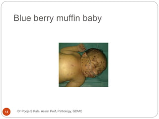 Muffin Rash Tumor and tumor like coditions of infancy and childhood | PPTX