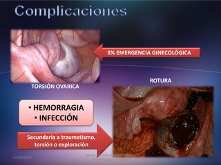 TORSIÓN OVARICA
3% EMERGENCIA GINECOLÓGICA
ROTURA
Secundaria a traumatismo,
torsión o exploración
• HEMORRAGIA
• INFECCIÓN
07/04/2016
JMGM - SESION DEPARTAMENTAL
GINECOLOGIA - CEMAIN
 