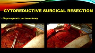 CYTOREDUCTIVE SURGICAL RESECTION
• Diaphragmatic peritonectomy
 
