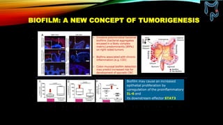 BIOFILM: A NEW CONCEPT OF TUMORIGENESIS
Biofilm may cause an increased
epithelial proliferation by
upregulation of the proinflammatory
IL-6 and
its downstream effector STAT3
 Invasive polymicrobial bacterial
biofilms (bacterial aggregates
encased in a likely complex
matrix) predominantly (89%)
on right-sided tumors
 Biofims associated with chronic
inflammation (e.g. CID)
 Colon mucosal biofilm detection
may predict increased risk for
development of sporadic CRC
E-cadherin P-STAT3IL-6
 
