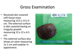 Gross Examination
• Received skin covered
soft tissue mass
measuring 13.5 x 13 x 5
cm. The external surface
is skin covered having an
irregular growth
measuring 13 x 12 x 4.5
cm.
• The external surface also
shows an ulcer measuring
1x 1 cm and nodular in
appearance.
 