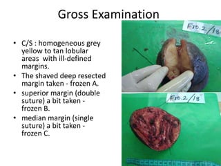 Gross Examination
• C/S : homogeneous grey
yellow to tan lobular
areas with ill-defined
margins.
• The shaved deep resected
margin taken - frozen A.
• superior margin (double
suture) a bit taken -
frozen B.
• median margin (single
suture) a bit taken -
frozen C.
 