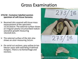 Gross Examination
273/18 - Container labelled excision
specimen of soft tissue Sarcoma
 Received skin covered soft tissue mass
measurement of the specimen-
13.5x13x5cm. The external surface shows
an irregular poorly circumscribed nodulo-
ulcerative growth measuring
13x12x4.5cm.
 The external surface of the skin also
shows an ulcer measuring 1x1cm.
 On serial cut sections, grey yellow to tan
lobular areas with extending ill defined
margins. There is no hemorrhage and
necrosis.
 