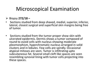 Microscopical Examination
 Biopsy 272/18 –
• Sections studied from deep shaved, medial, superior, inferior,
lateral, closest surgical and superficial skin margins being free
of tumor.
• Sections studied from the tumor proper show skin with
ulcerated epidermis. Dermis shows a tumor composed of
round to ovoid cells with nucleus showing moderate
pleomorphism, hyperchromatic nucleus arranged in solid
clusters and in lobules. Few cells are spindly. Occasional
atypical mitoses are seen. Tumor is infiltrating upto
subcutaneous fat. Several small cleft like spaces are seen
resembling synovial lining with tumor cells projecting into
these spaces.
 