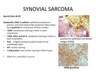 SYNOVIAL SARCOMA
Special Stains & IHC
Cytokeratin, EMA, E-cadherin: epithelial component is
positive, and mesenchymal-like component often shows
focal positivity for at least one of these markers:
• CD99: membranous staining in either or both
components.
• CD56, CD57, and bcl-2: cytoplasmic staining in either or
both components.
• TLE1 - a highly sensitive (nuclear) marker for all
morphologic types.
• SYT: nuclear staining.
• S-100 protein: focal nuclear staining in 33% of cases.
• CD34, Fli-1, and CD117 negative.
CD99 (positive)
positive for epithelial membrane
antigen (EMA)
 