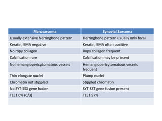 Fibrosarcoma Synovial Sarcoma
Usually extensive herringbone pattern Herringbone pattern usually only focal
Keratin, EMA negative Keratin, EMA often positive
No ropy collagen Ropy collagen frequent
Calcification rare Calcification may be present
No hemangiopericytomatous vessels Hemangiopericytomatous vessels
frequent
Thin elongate nuclei Plump nuclei
Chromatin not stippled Stippled chromatin
No SYT-SSX gene fusion SYT-SST gene fusion present
TLE1 0% (0/3) TLE1 97%
 
