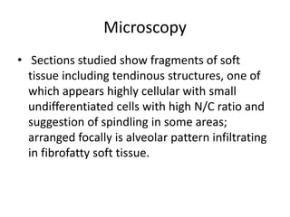 Microscopy
• Sections studied show fragments of soft
tissue including tendinous structures, one of
which appears highly cellular with small
undifferentiated cells with high N/C ratio and
suggestion of spindling in some areas;
arranged focally is alveolar pattern infiltrating
in fibrofatty soft tissue.
 